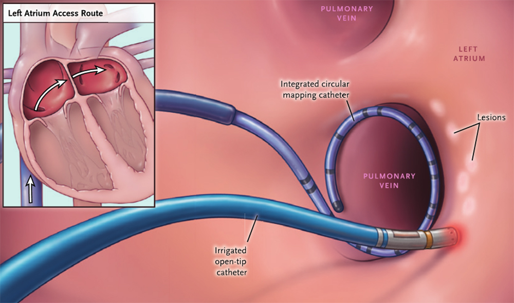 afib ablation